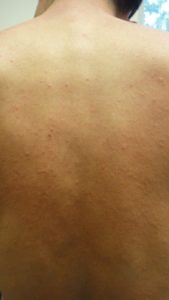 Allergic reaction to bed bug bites causing a widespread rash across the upper body
