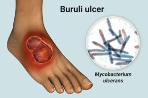 buruli ulcer