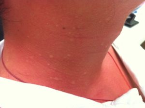 Bed bug allergy causing rash on neck